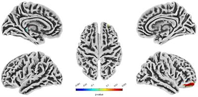 Abnormal changes in neuropsychological function, brain structure and cerebral perfusion in patients with unruptured intracranial aneurysms